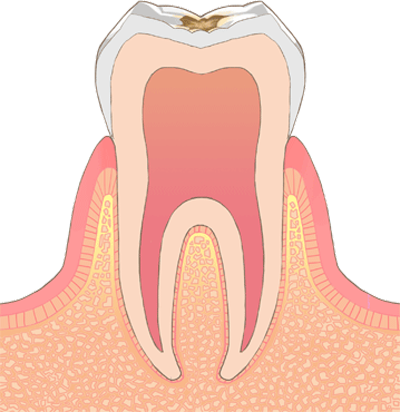 Ｃ1　(初期の虫歯)