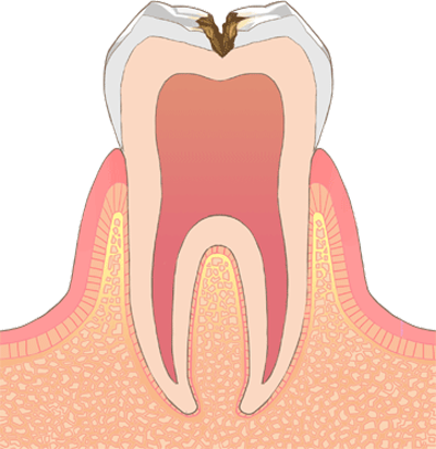Ｃ2　(中期の虫歯)