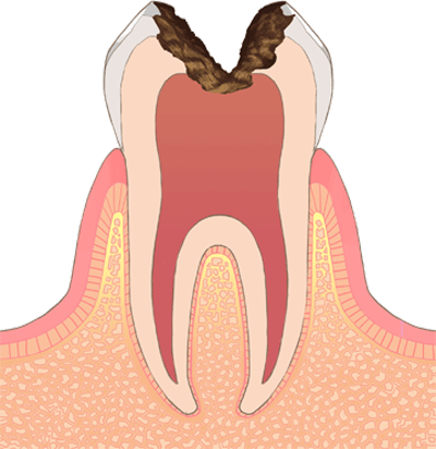 Ｃ3　(後期の虫歯)