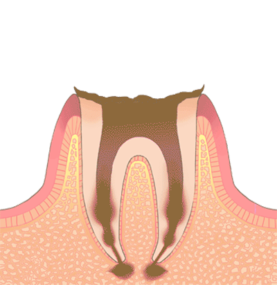 Ｃ4　(末期の虫歯)