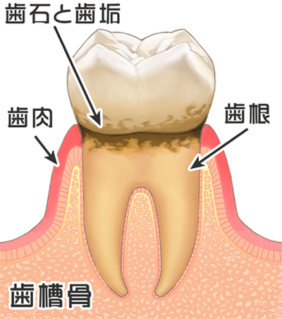 歯周炎