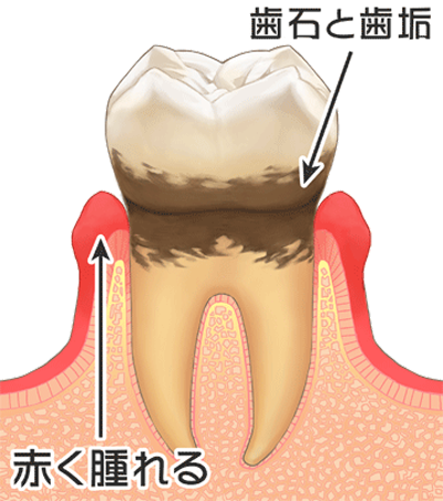 初期の歯周病