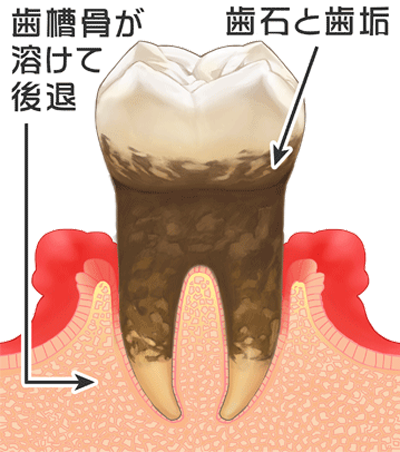 中期の歯周病