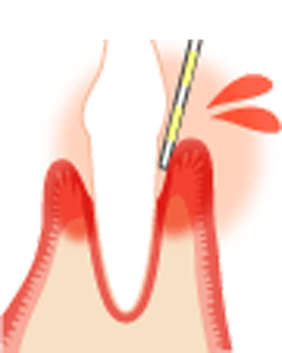 歯周病検査・レントゲン検査