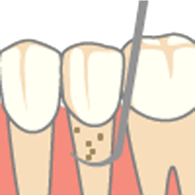 深い部分の歯石除去