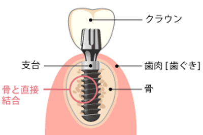 インプラントとは