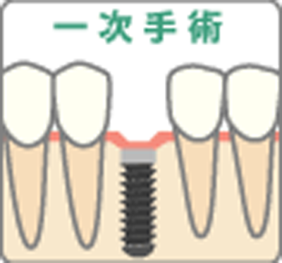 インプラント埋入手術