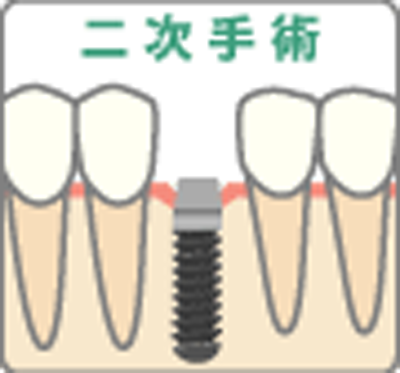 第2次手術